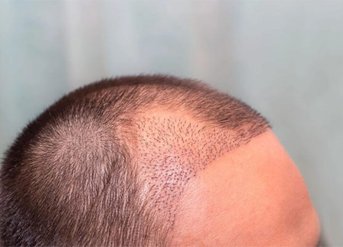 Warum ist die FUE-Haartransplantation in der Türkei so beliebt